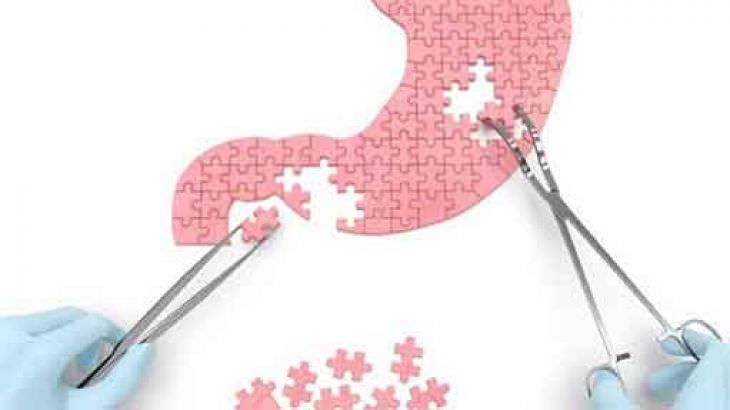 Tüp Mide Ameliyatı (Sleeve Gastrektomi)