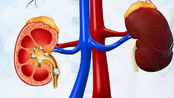 Böbrek Taşı Nedir? Nasıl Tedavi Edilir?