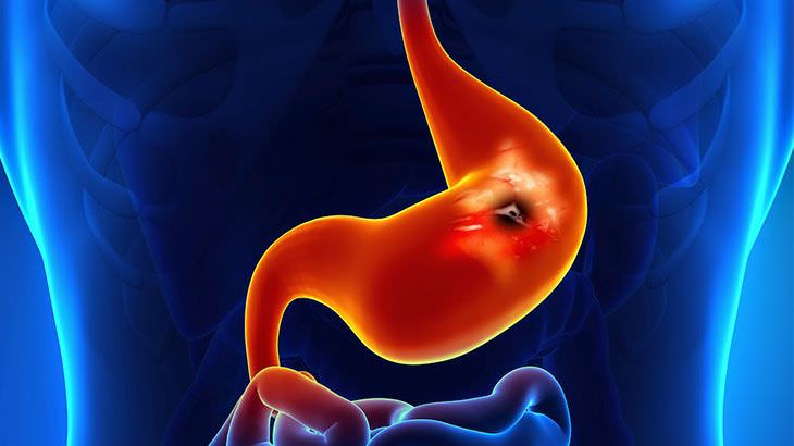 Mide Kanaması Nedir? Nasıl Tedavi Edilir?