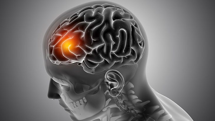 Beyin Tümörleri Nedir? Belirtileri Nelerdir? Tedavi Yöntemleri Nelerdir?