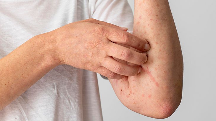 Uyuz Hastalığı Nedir? Tedavi ve Belirtileri Nelerdir?