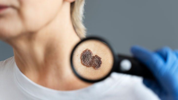 Kelebek Hastalığı (Lupus) Hastalığı Nedir? Belirtileri Nelerdir? Tanı ve Tedavisi Nasıl Yapılır?