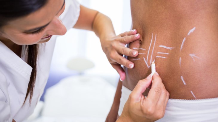 Karın Germe (Abdominoplasti) Nedir? Nasıl Uygulanır? Nelere Dikkat Edilmelidir?