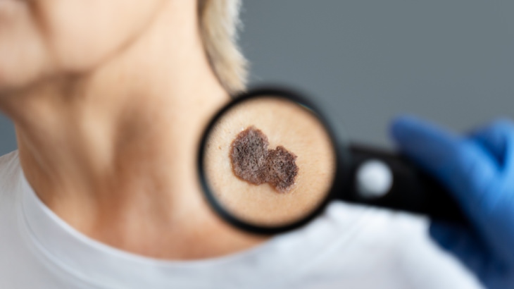 Cilt (Deri) Kanseri Nedir? Belitileri ve Tedavi Yöntemleri Nelerdir?